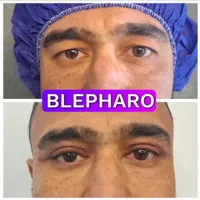 دروغ ممنوع/ بلفاروپلاستی جراحی پلک|خدمات آرایشگری و زیبایی|تهران, پونک|دیوار