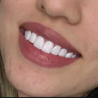 ایمپلنت بلندمدت/کامپوزیت/لمینت/درمانی|خدمات آرایشگری و زیبایی|مرند, |دیوار