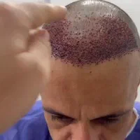 کاشت مو|خدمات آرایشگری و زیبایی|ایلام, |دیوار