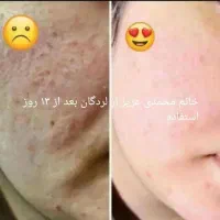 با این کرم فقط با ده روز پوستت رو فوق العاده کن|آرایشی، بهداشتی، درمانی|لردگان, |دیوار