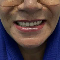 دندانسازی (دندان مصنوعی) اقساطی