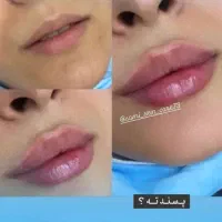 تخفیف تزریق ژل و بوتاکس برای خانم ها و آقایون|خدمات آرایشگری و زیبایی|شاهینشهر, خانه کارگر|دیوار