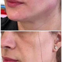 تزریق ژل و بوتاکس با تخفیفات بی نظیر به مدت محدود|خدمات آرایشگری و زیبایی|مشهد, فرهنگ|دیوار