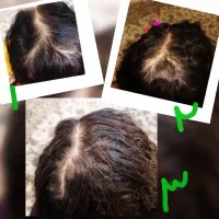بوتاکس. فیلر. مزوتراپی. فشیال|خدمات آرایشگری و زیبایی|تهران, زاهد گیلانی|دیوار