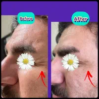 بوتاکس/پی آر پی/ژل لب/لیزر /مسکن|خدمات آرایشگری و زیبایی|کرمانشاه, |دیوار