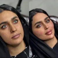 فیلر بادی ژل بوتاکس مزو لیزر هایفو فول فیس ۵۰٪ آف