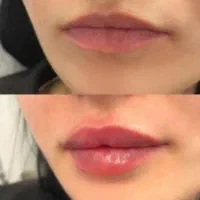 تزریق ژل و بوتاکس توسط پزشک لیزر موهای زاید|خدمات آرایشگری و زیبایی|تهران, هفت حوض|دیوار