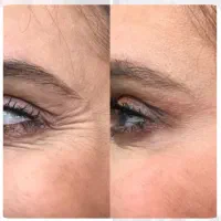 ژل بوتاکس مزوتراپی جوانساز فشیال پاکسازی|خدمات آرایشگری و زیبایی|اندیشه, اندیشه فاز ۱|دیوار