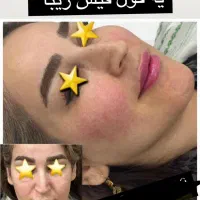 تزریق ژل و بوتاکس و پی ارپی و مزوتراپی و لیزر مو|خدمات آرایشگری و زیبایی|بوشهر, |دیوار