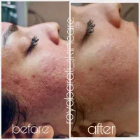 جوانسازی ورفع جای جوش بامیکرونیدلینگ کلینیک زیبایی|خدمات آرایشگری و زیبایی|اصفهان, جلفا|دیوار