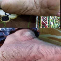 درمان ترک پا