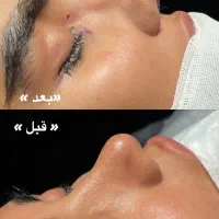 جراحی بینی، پیکر تراشی ترانسفر باسن + شرایط اقساطی|خدمات زیبایی و سلامت|اصفهان, ملکشهر|دیوار
