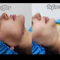 ساکشن شکم پهلو غبغب تزریق چربی ژل بوتاکس|خدمات آرایشگری و زیبایی|کرمانشاه, |دیوار