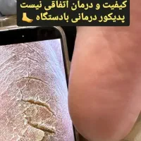 درمان خشکی و ترک کف پا درمانی با دستگاه