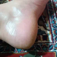 از بین بردن ترک پاشنه پا در یک جلسه  تضمینی|خدمات آرایشگری و زیبایی|شیراز, ماه فیروزان|دیوار