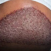 تکنیسین کاشت موو