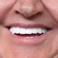 ایمپلنت دندان اقساطی در تبریز توسط پزشک متخصص