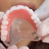 دست دندان‌ لثه ژله ای طرح لمینیت