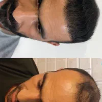 کاشت مو‌ ،ریش و ابرو