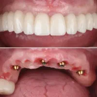 جشنواره کلیه خدمات دندانپزشکی با اقساط ۱۵ ماهه