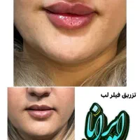 تزریق ژل و بوتاکس تضمینی (کلنیک ایرانا)|خدمات آرایشگری و زیبایی|یاسوج, |دیوار