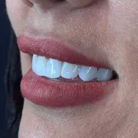 دندان‌پزشکی.لمینت.کامپوزیت|خدمات آرایشگری و زیبایی|تهران, زرکش|دیوار
