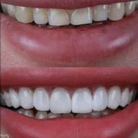 دندانپزشکی تخفیف عیدانه قیمت ها معادل با بیمه