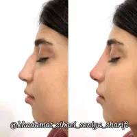 تخفیف ویژه ژل و بوتاکس تا یک هفته|خدمات آرایشگری و زیبایی|اهواز, منبع اب|دیوار