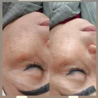 پاکسازی صورت|خدمات آرایشگری و زیبایی|زنجان, |دیوار