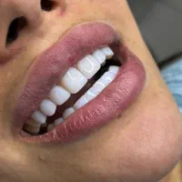 کامپوزیت دندان