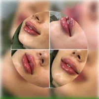 بوتاکس،فیلر توسط پزشک پوست و زیبایی(تخفیف استثنایی|خدمات آرایشگری و زیبایی|تهران, دروس|دیوار