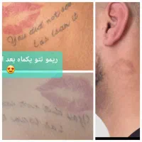 لیزر موهای زائد،  لیزر ریمو تتو