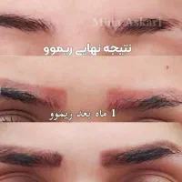 ریموو تاتو تک جلسه ای|خدمات آرایشگری و زیبایی|تربتحیدریه, طالقانی|دیوار