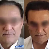 کاشت مو سوزن ۰/۷،کاشت ابرو کره ای(تیم شیراز در یزد|خدمات آرایشگری و زیبایی|یزد, |دیوار
