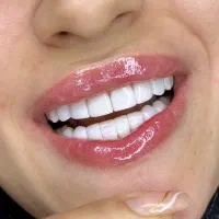 مدل کامپوزیت دندان|خدمات آرایشگری و زیبایی|تهران, هاشمی|دیوار