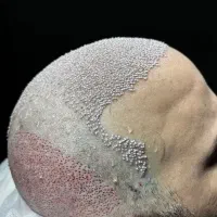 جشنواره ویژه کاشت تخصصی موشیرازی ۸میلیون باضمانت|خدمات زیبایی و سلامت|تهران, پاسداران|دیوار