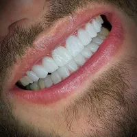 کامپوزیت لمینت ایمپلنت با اقساط ویژه