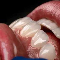 کامپوزیت زیبایی دندان(شهرستان بناب)