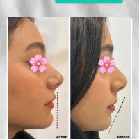 ژللب روسی با بوتاکس پیشانی فقط ۲/۵۰۰ توسط پزشک