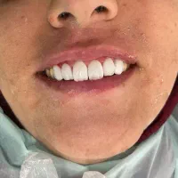 تخفیف وام دندانپزشکی ایمپلنت کامپوزیت روکش عصب کشی|خدمات آرایشگری و زیبایی|بروجرد, |دیوار