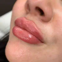 ژل فیلر بوتاکس مزو هایفو لیزر نخ