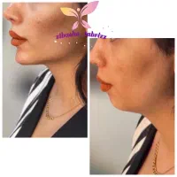 آموزش تزریق ژل بوتاکس مزو نخ ودیگر لاین های زیبایی|خدمات آموزشی|تبریز, |دیوار