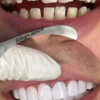 آف ویژه کامپوزیت و زیبایی دندان