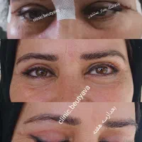 جشنواره بلفاروپلک بالاوپایین،اتوپلاستی،لابیاپلاستی