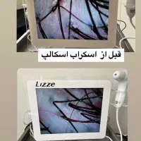 اسکراب اسکالپ(پاکسازی و درمان پوست سر)|خدمات آرایشگری و زیبایی|کرج, مطهری|دیوار