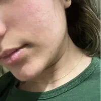 لیزر co2 تخفیف ویژه حذف اسکار،منافذوتیرگی ها مزو|خدمات آرایشگری و زیبایی|تهران, زعفرانیه|دیوار