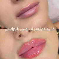 فیلر بوتاکس چربی لیزر