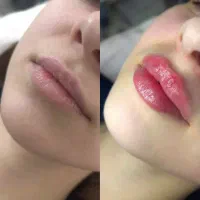 ژل ،بوتاکس،مزوتراپی مو، خال برداری ،لیزر مو