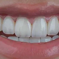 کامپوزیت زیبایی کلینیک دکتر کوهفر