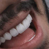 دندانپزشکی ایمپلنت دیجیتال روکش اوردنچر کامپوزیت